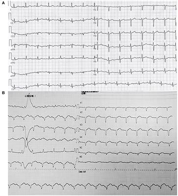 Frontiers | Case Report: Takotsubo Syndrome Induced by Severe